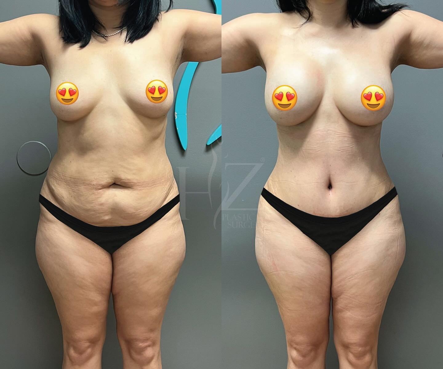 Our latest mommy makeovers 🔥 

1: Tummy tuck, breast augmentation, and liposuction on the waist and back bra roll by @drafsharihzps at 6 weeks post-op
2: Tummy tuck, liposuction on waist/back bra roll/front bra roll, and breast reduction by @drlylyh