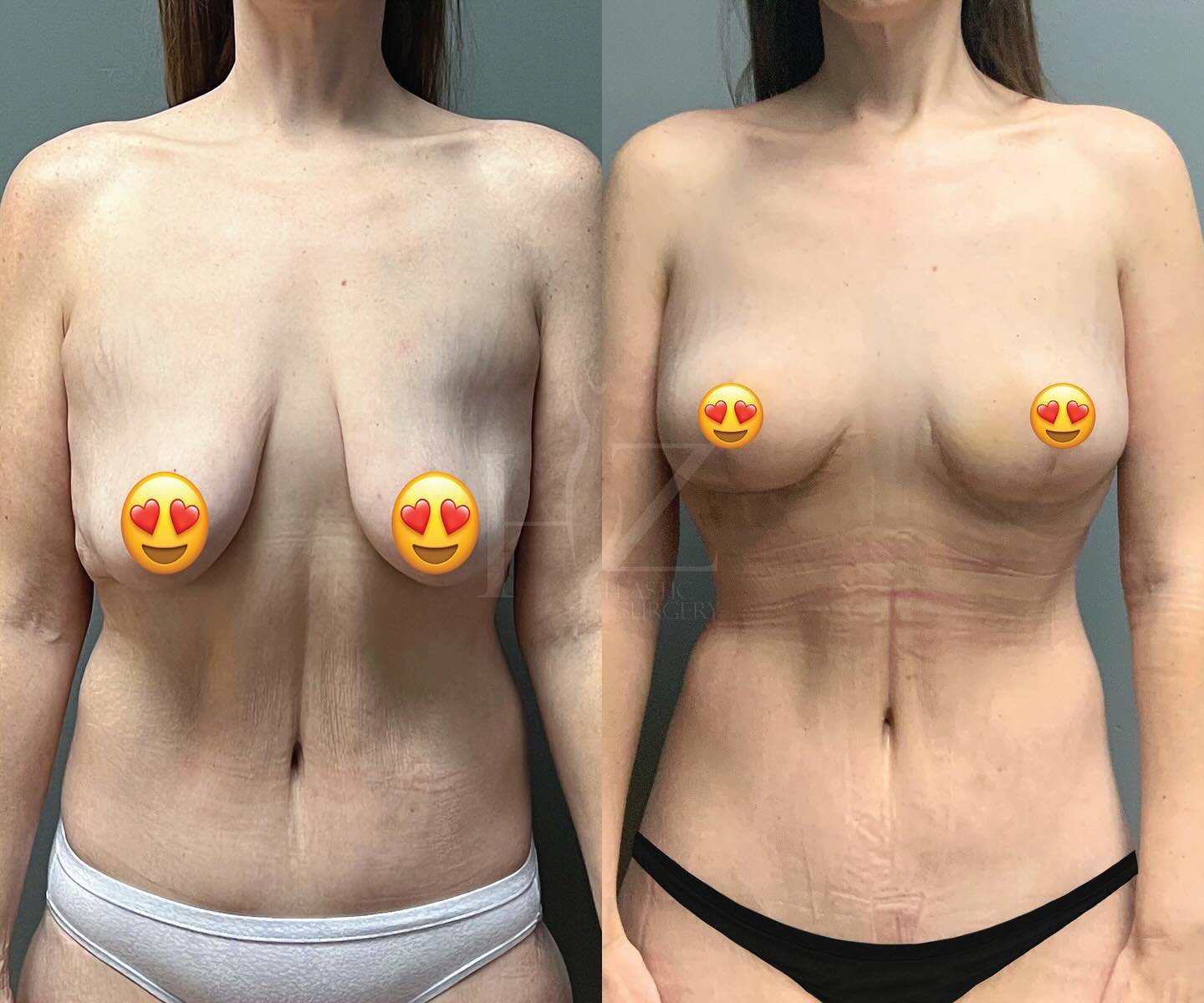 Breast lift after 200lb weight loss 🔥 
@drzhzps performed a breast lift with liposuction on the waist on our beautiful patient to achieve this natural-looking result. No implants involved! Results are 6 weeks post-op.

𝐏𝐫𝐞-𝐎𝐩 𝐒𝐭𝐚𝐭𝐬:
Age: 4