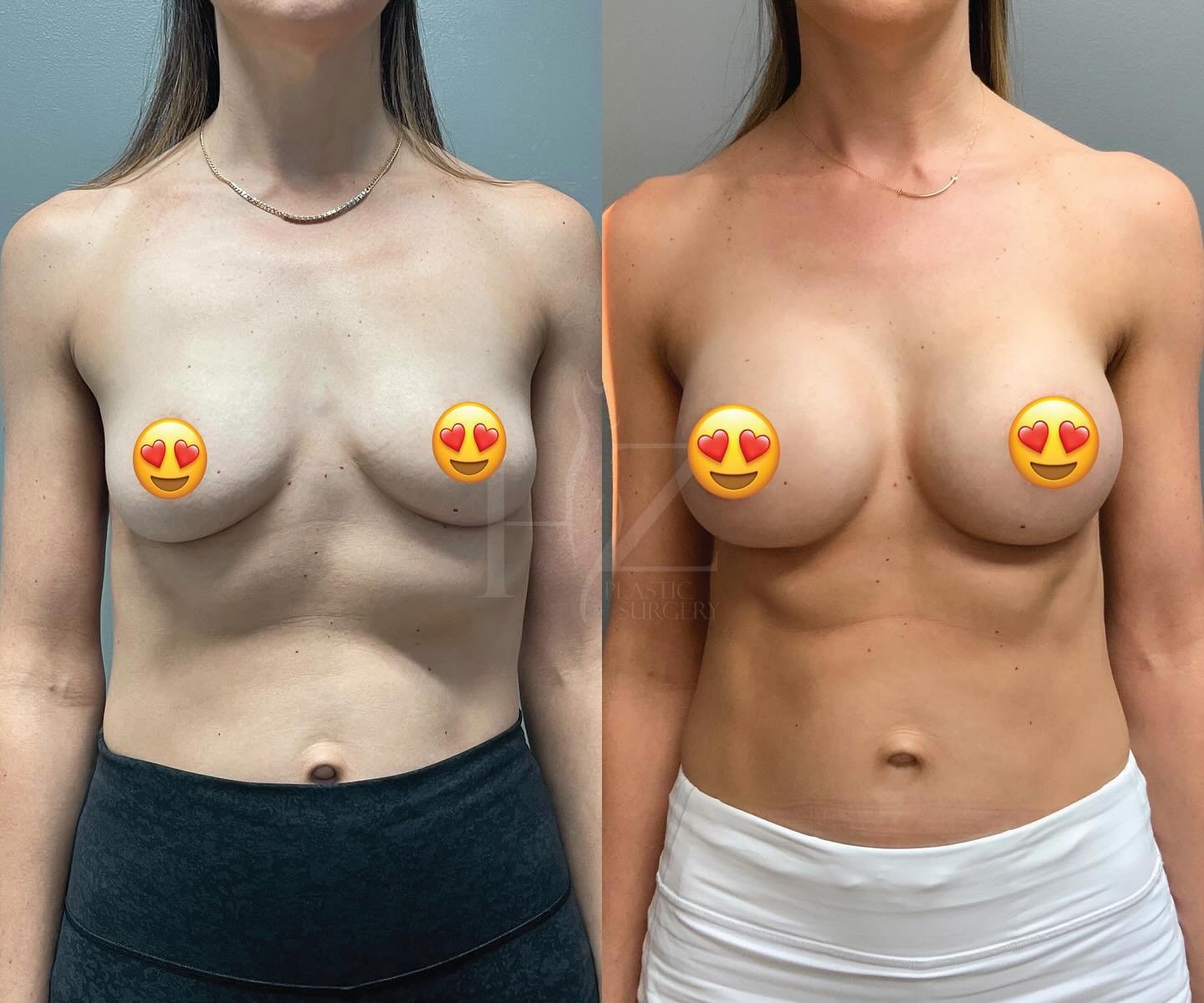 Enhanced volume and shape with full profile 345cc implants 🍒 
@drlylyhzps performed a breast augmentation on our gorgeous patient for these beautiful results at 6 weeks post-op!

𝐏𝐫𝐞-𝐎𝐩 𝐒𝐭𝐚𝐭𝐬:
Age: 39, Height: 5ft 9in, Weight: 130lbs, BMI: