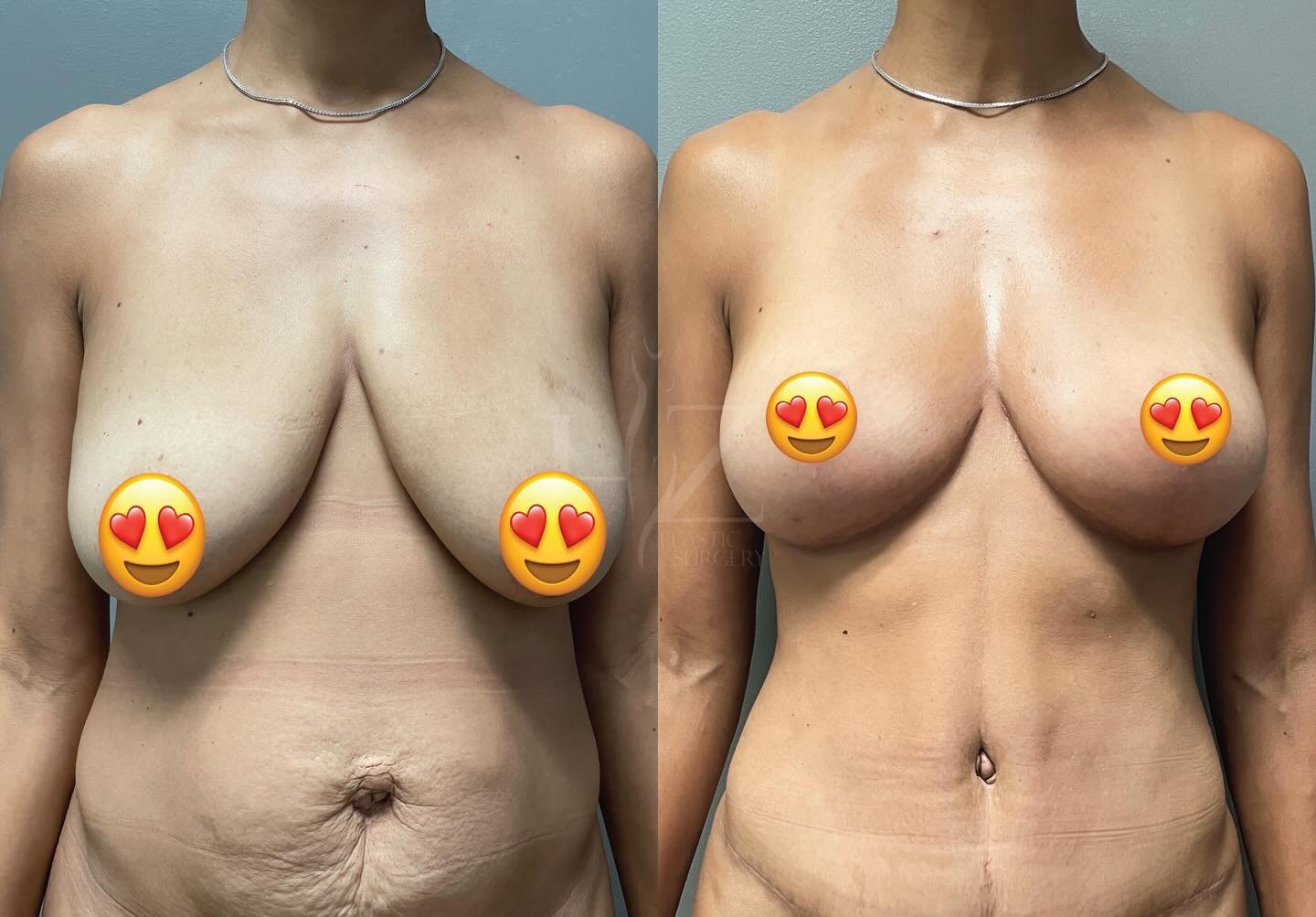 A moment for her breast transformation ✨😍 
Our beautiful patient, a 44-year-old mom of 2, received a stunning breast lift without implants by @drlylyhzps! She also underwent a tummy tuck and liposuction on the waist. These amazing results are just 3