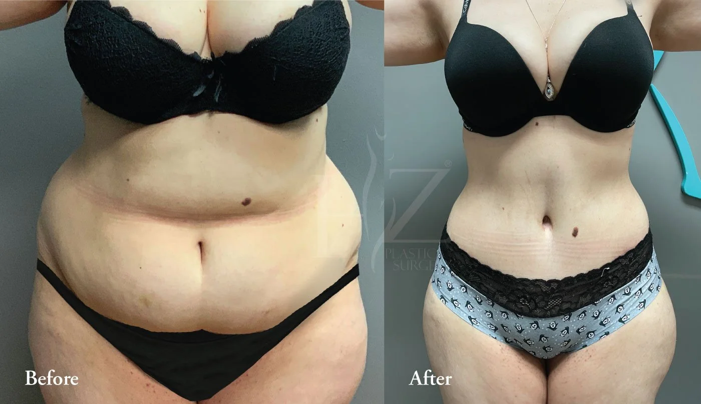 Full Tummy Tuck Vs Mini Tummy Tuck Which Is Best For Me?, mini tummy