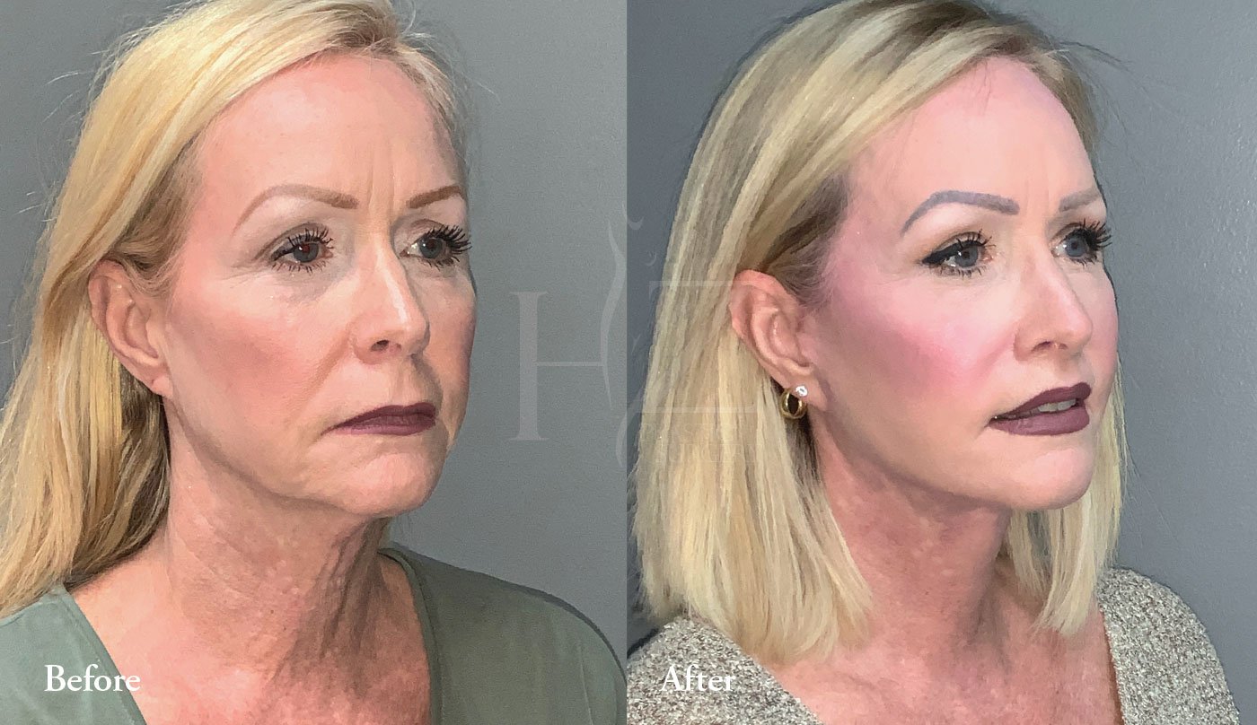 Facelift In Orlando — HZ Plastic Surgery