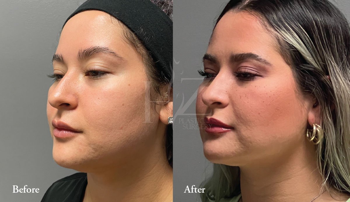 Buccal Fat Removal In Orlando — HZ Plastic Surgery