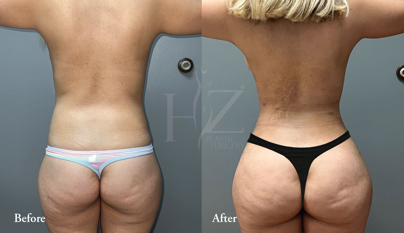 Brazilian Butt Lift Before & After — HZ Plastic Surgery