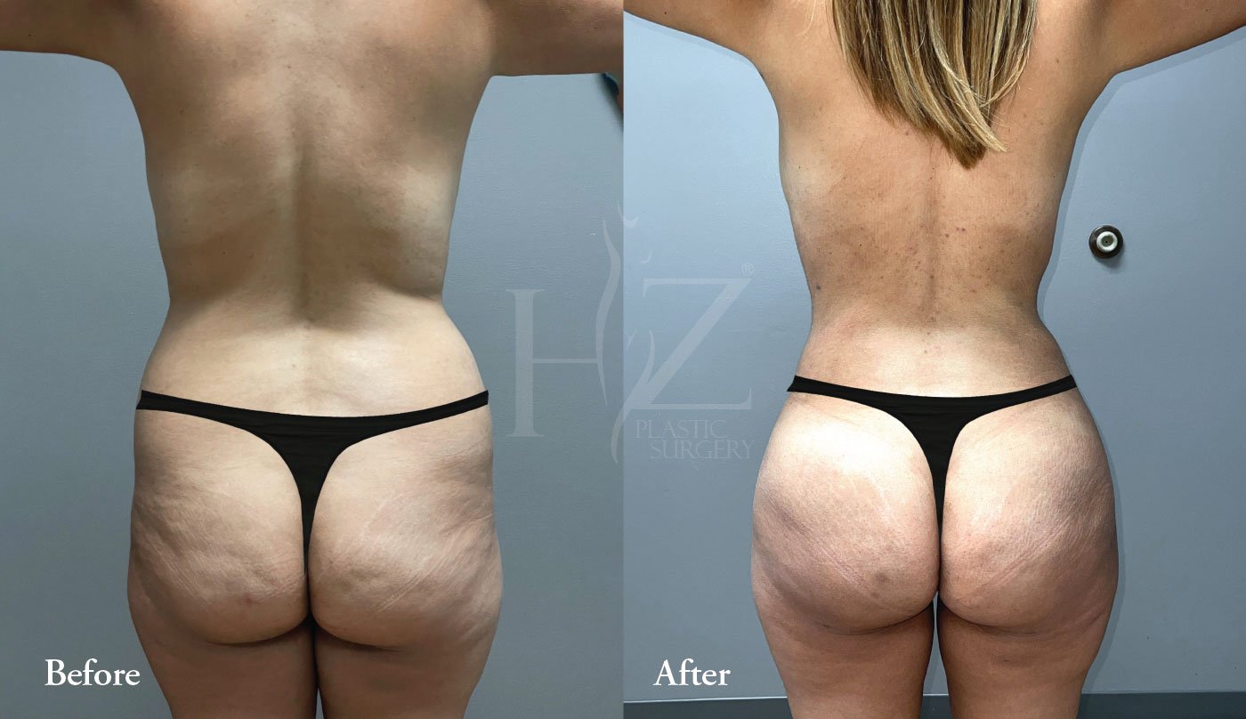 Brazilian Butt Lift Before & After — HZ Plastic Surgery