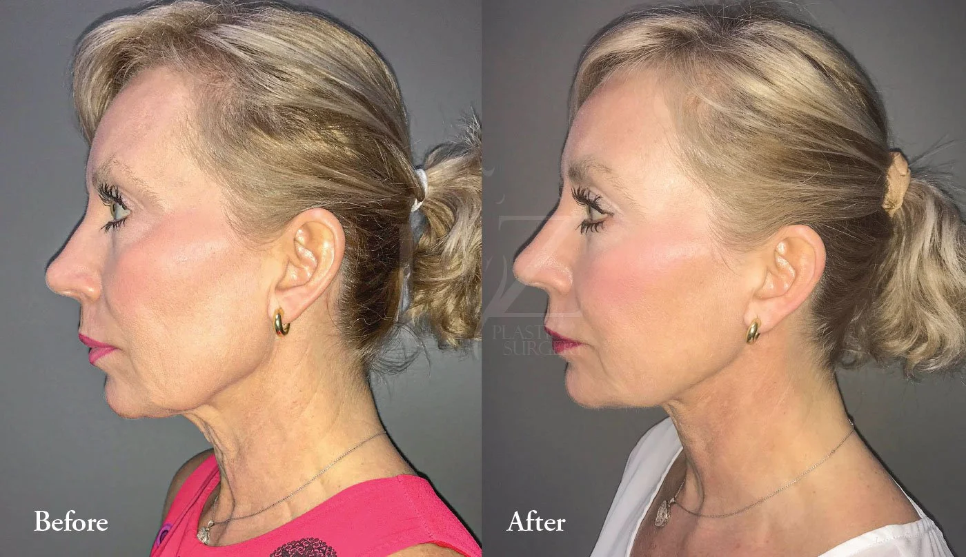 Facelift Before & After — HZ Plastic Surgery