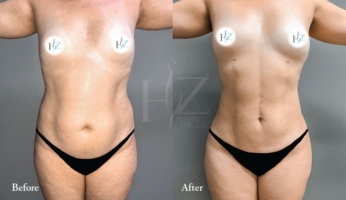 Tummy Tuck vs Liposuction: Which Is Right For You? — HZ Plastic