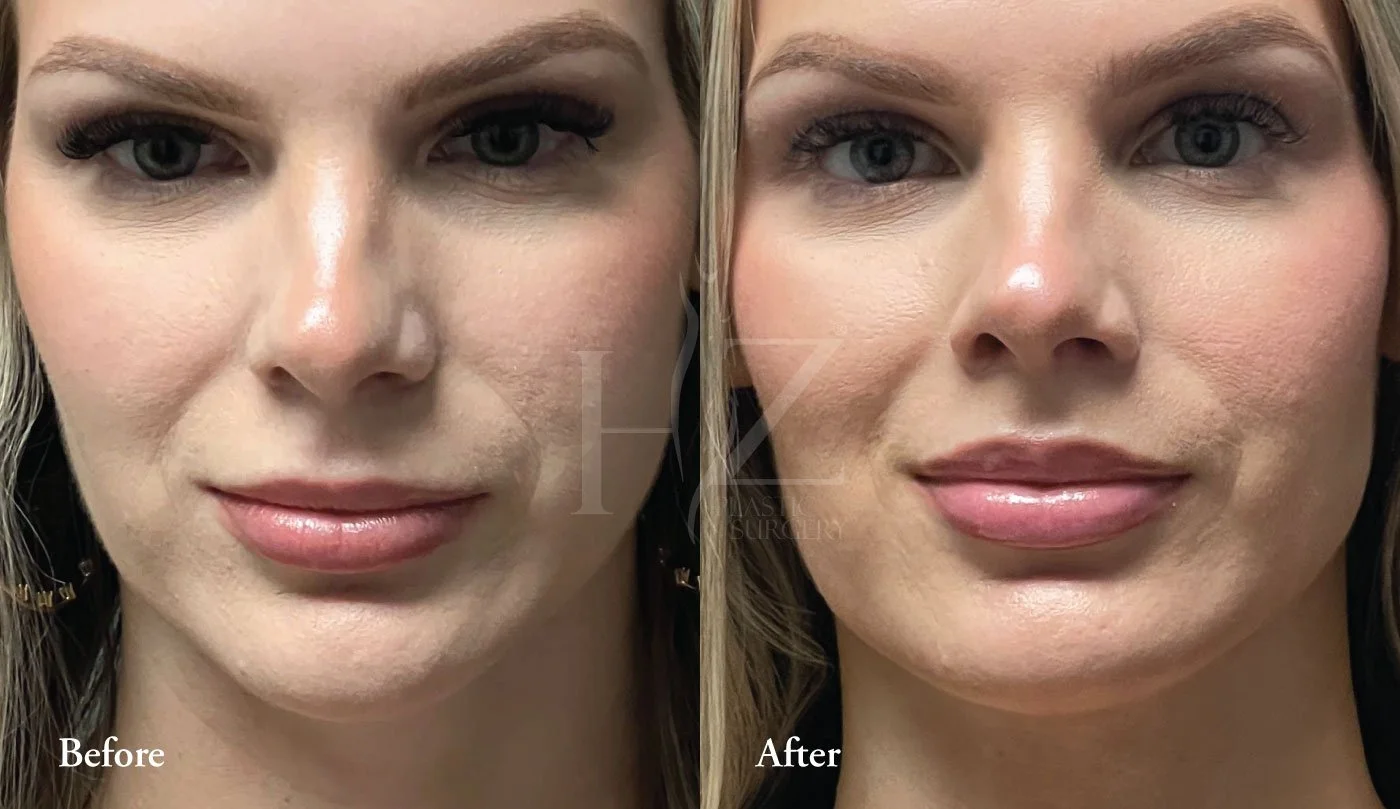 Upper Lip Lift In Orlando — HZ Plastic Surgery