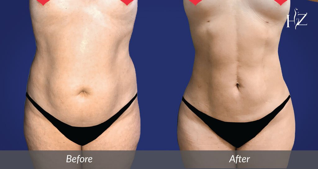 Liposuction vs Tummy Tuck: What's Right For Me?