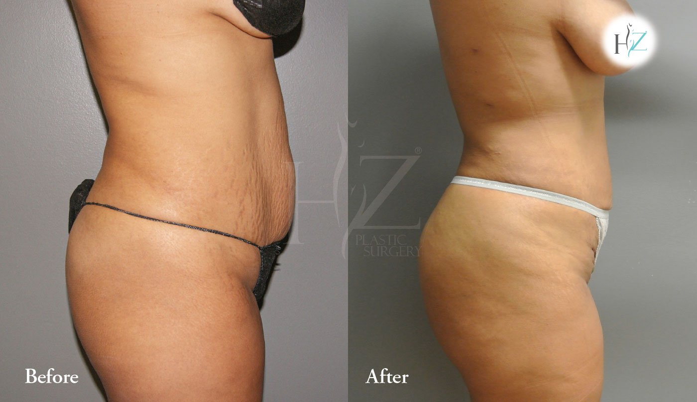 Brazilian Butt Lift Before and After - Dr. Kalantarian Plastic Surgery