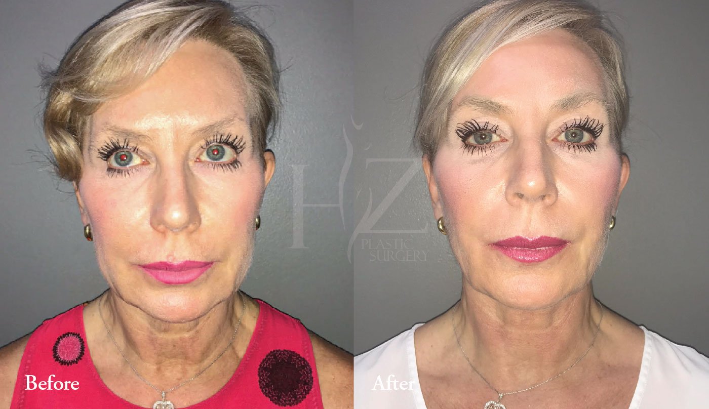 Facelift Before & After — HZ Plastic Surgery