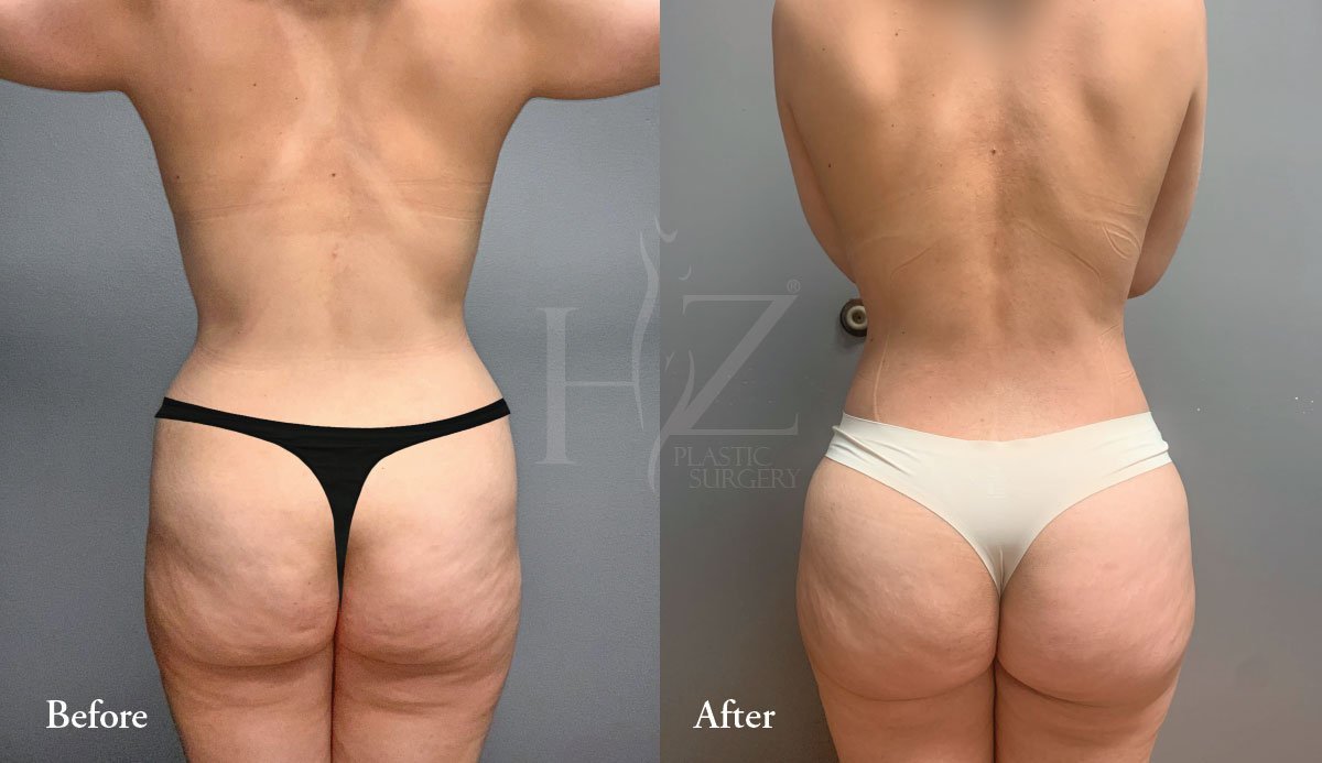 BBL BEFORE + AFTER  A BBL Brazilian Butt Lift, is a cosmetic