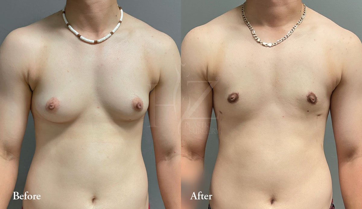 How Long is Recovery from MtF Top Surgery?, Boston MtF Top Surgery