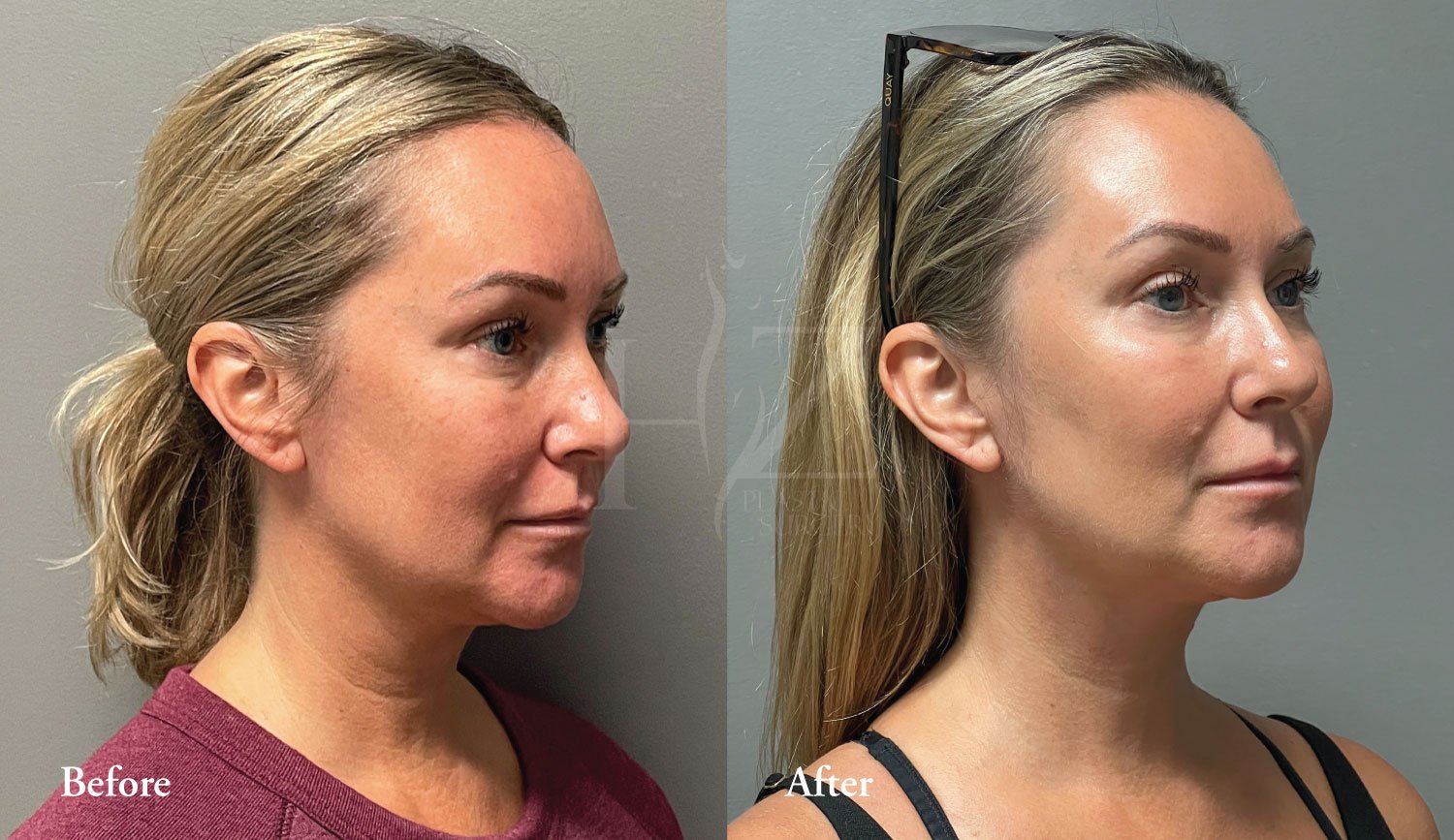 Facelift In Orlando — HZ Plastic Surgery