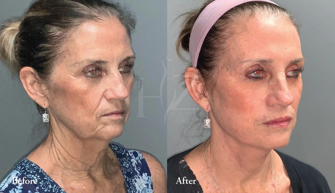 Facelift Before & After — HZ Plastic Surgery