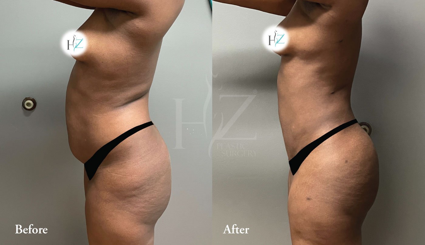 The Brazilian Butt Lift - Parakh Plastic Surgery