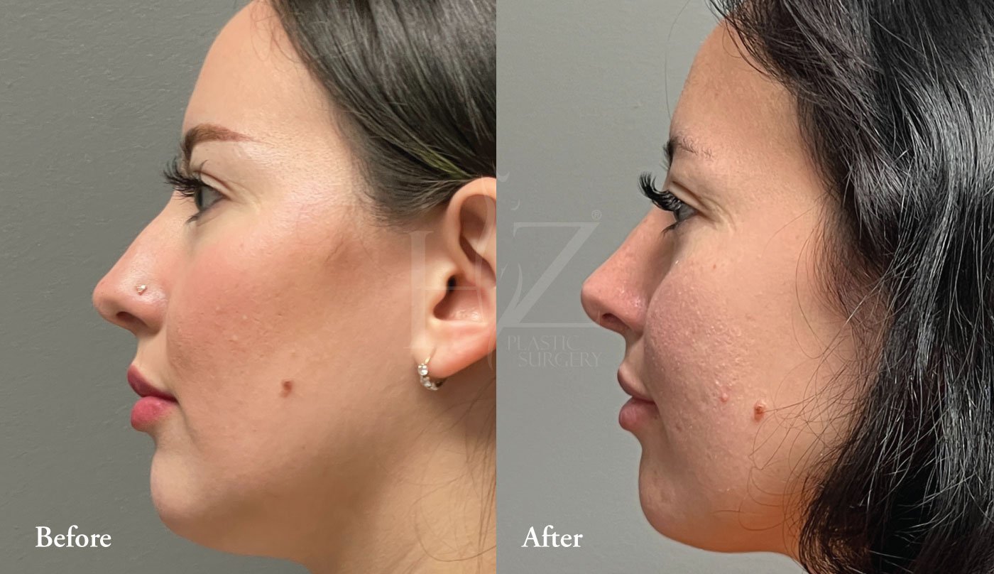 Upturned Nose – Rhinoplasty Orlando Nose Job