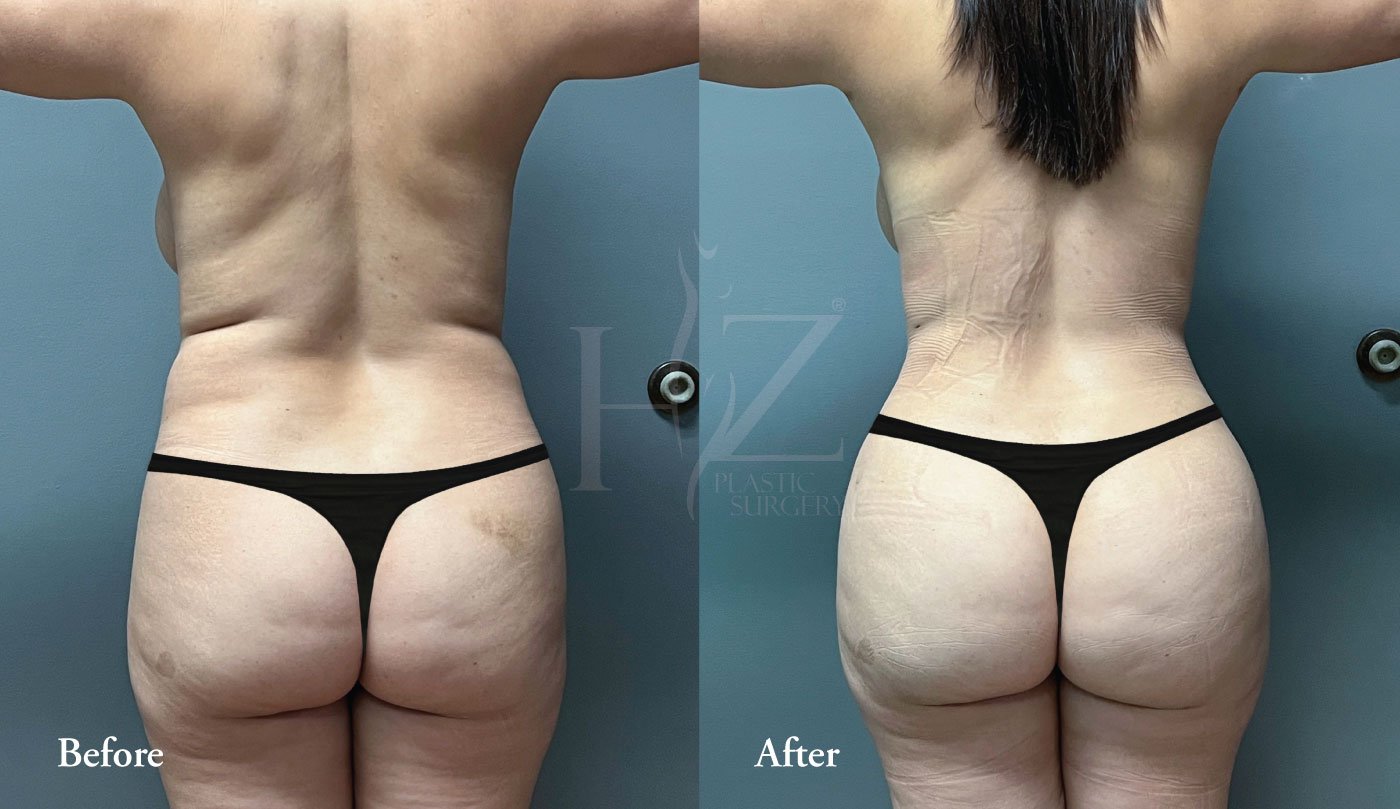The Brazilian Butt Lift - Parakh Plastic Surgery