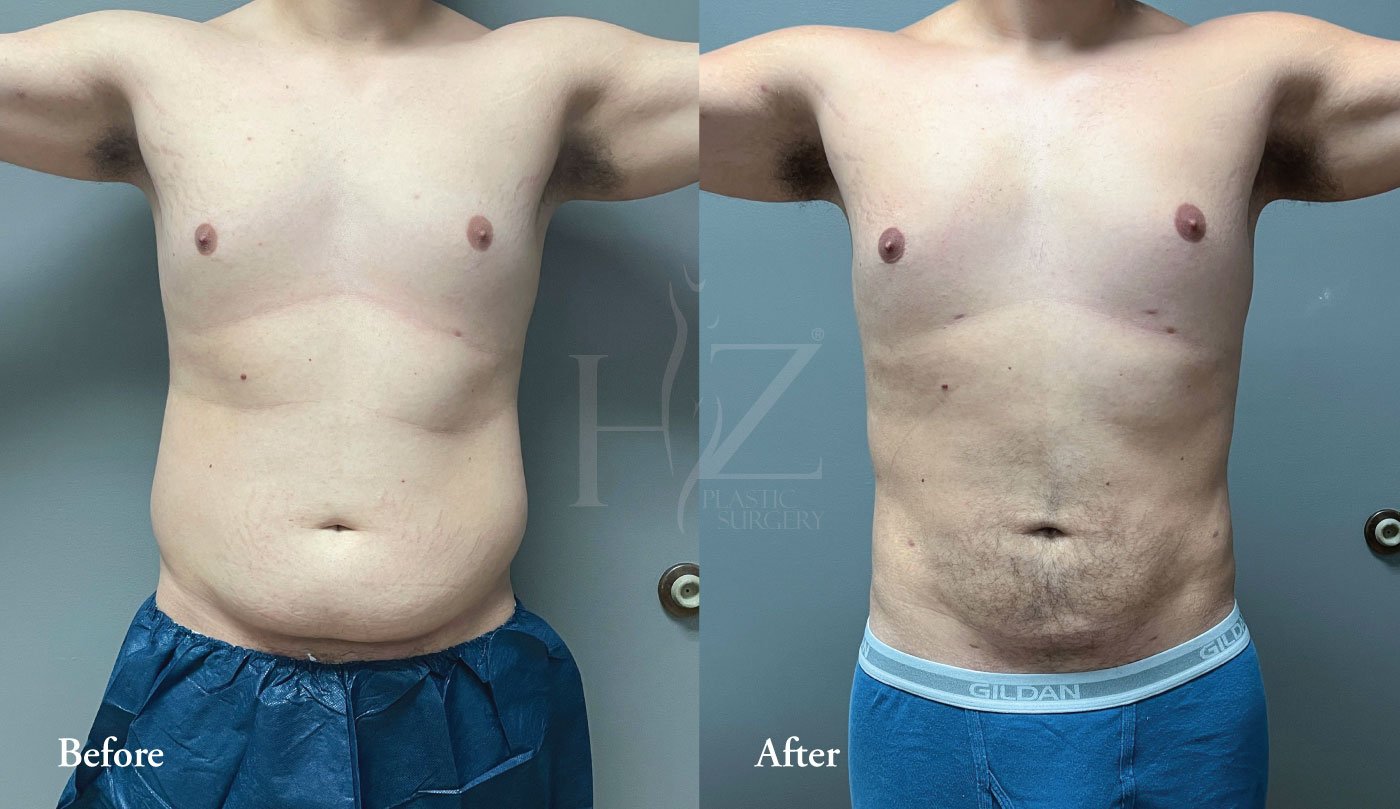 Liposuction Before & After — HZ Plastic Surgery