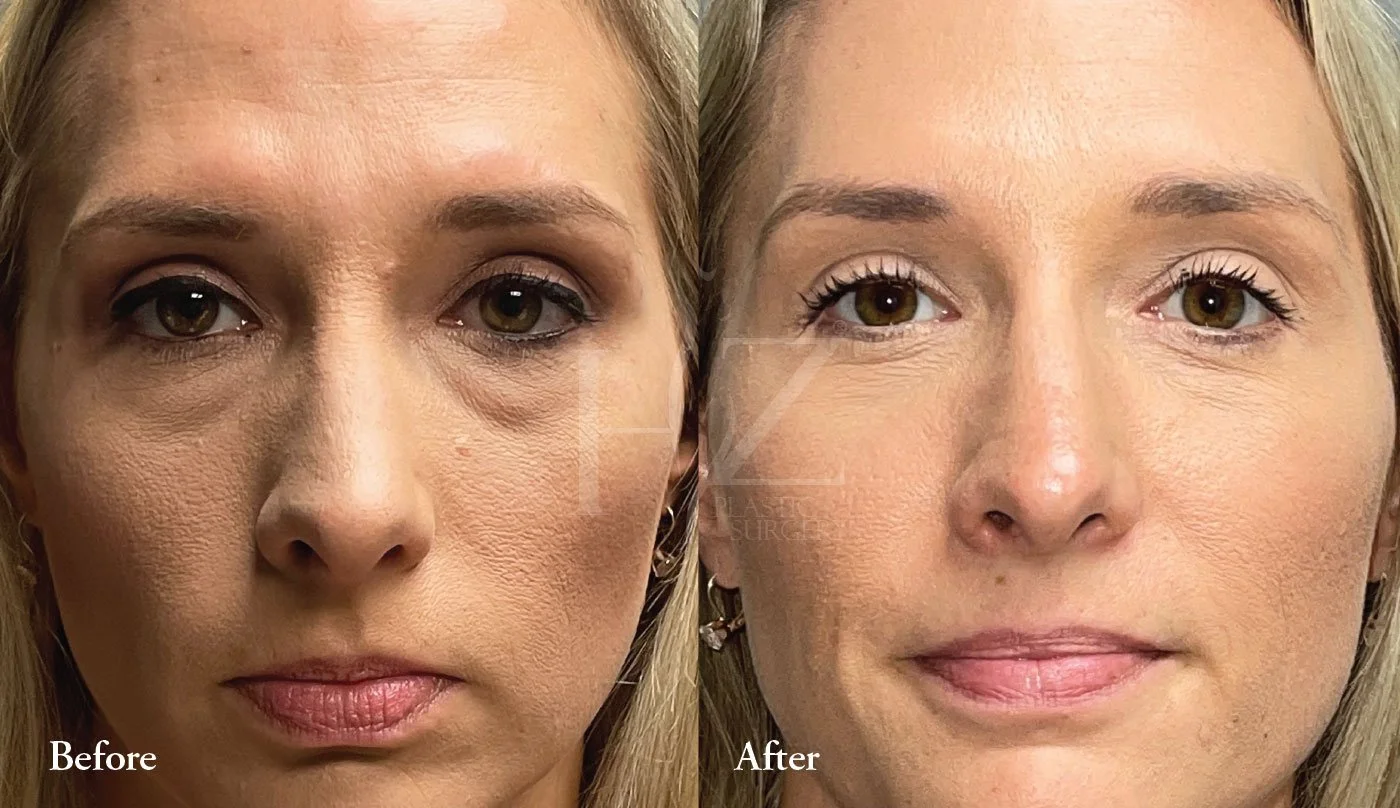Blepharoplasty Before & After — HZ Plastic Surgery
