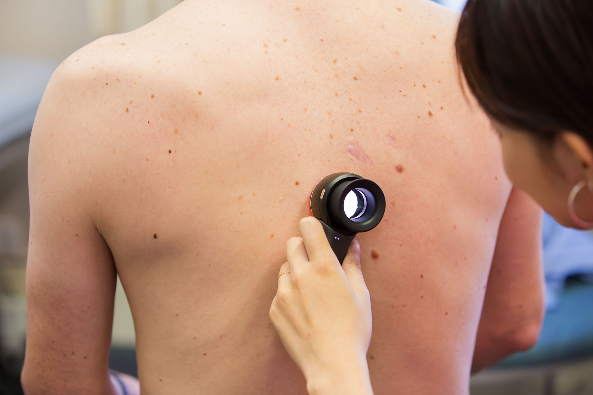 Crawford Medical Centre in Howick, Auckland provides comprehensive mole mapping. Contact us today to schedule your appointment with one of our Doctors.