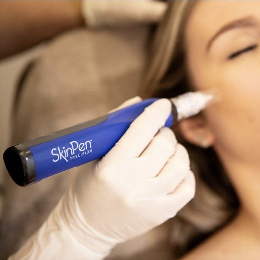 Microneedling in Kitchener Waterloo (SkinPen Treatment)