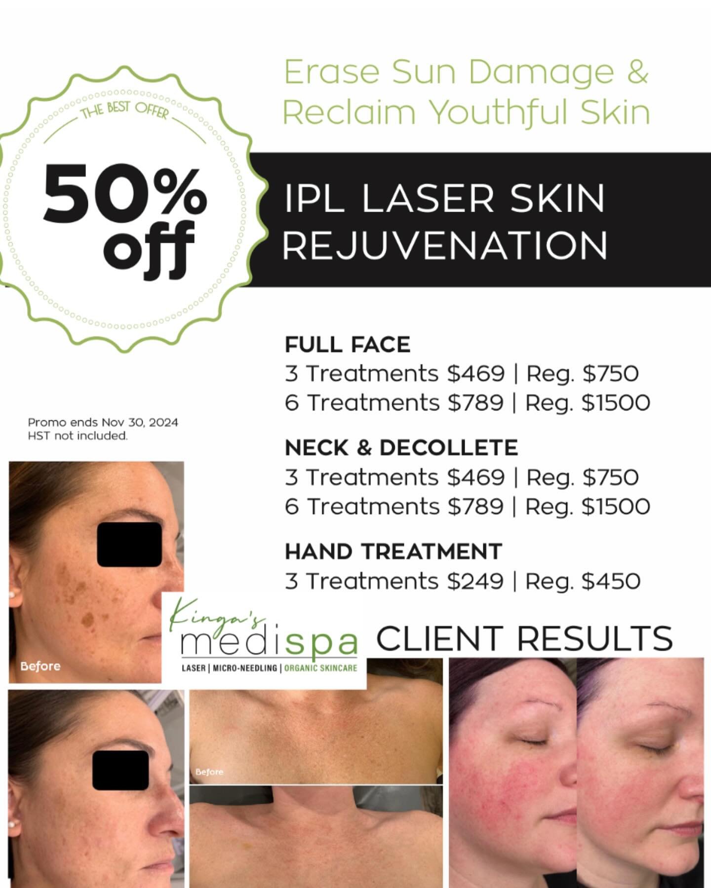 Exited to announce our Laser Skin Rejuvenation Promotion for this year! Up to 50% Off!

Who are the best candidates for this treatment?
- if you have sun damage, pigmantation
-if you have fine line/ wrinkles
-if you have rosacea / broken capillaries/