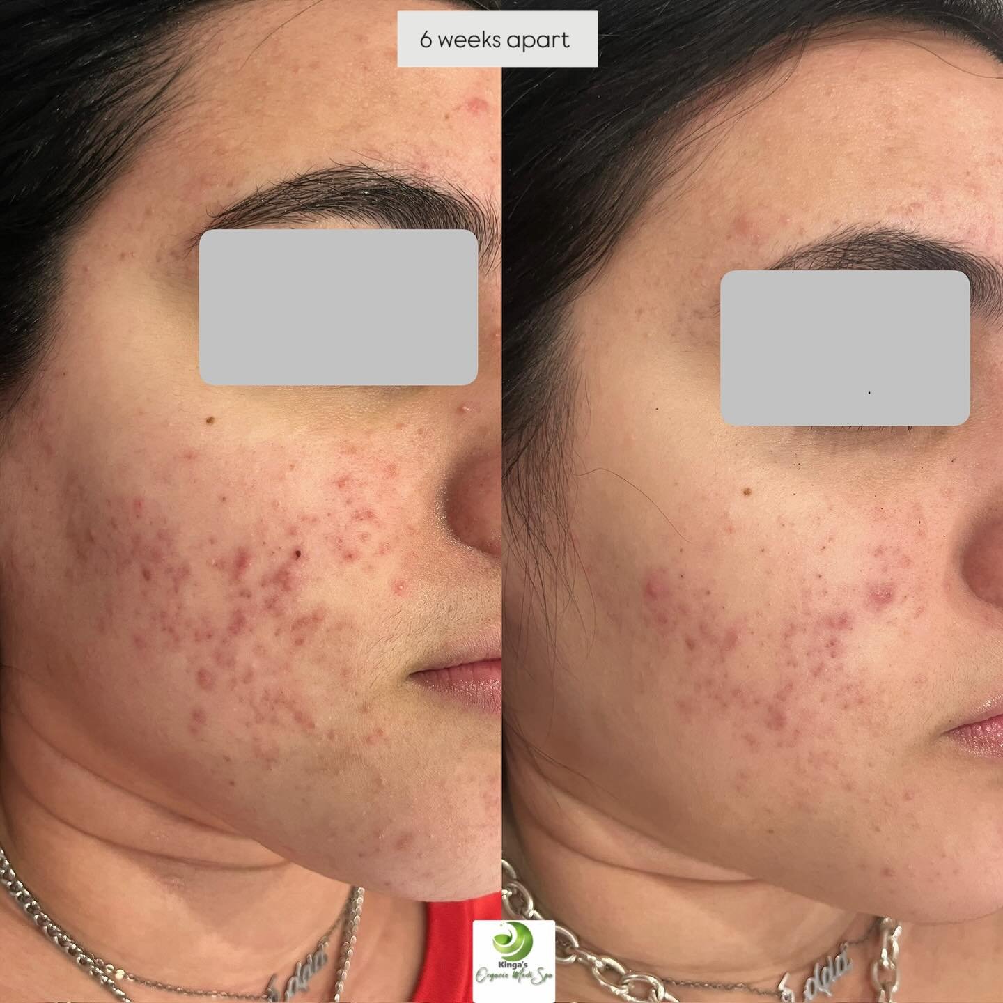Struggling with acne? Just know there is natural ways to heal acne without taking acutane, antibiotics , birth control pills, 
We offer different acne programs targeted to your specific acne type, 
With life style changes, customized home skin care r