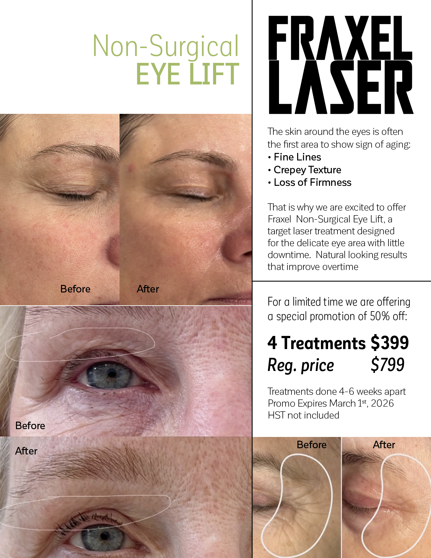 Non Surgical Eye Lift - FRAXEL