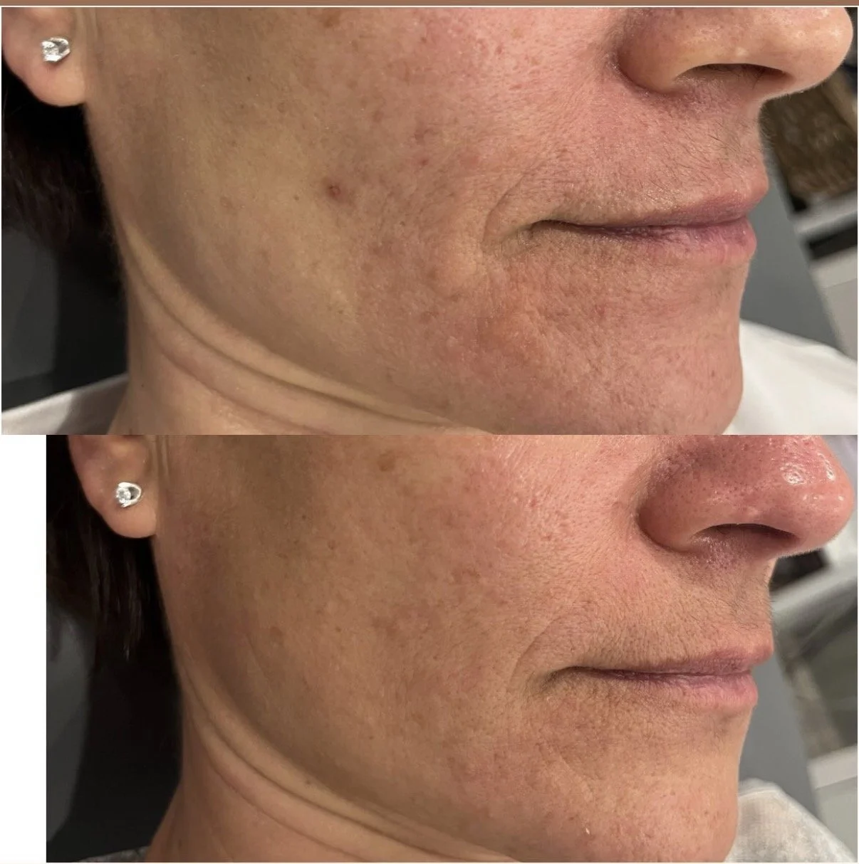 Microneedling - Before &amp; After - Kinga's Organic Medi Spa