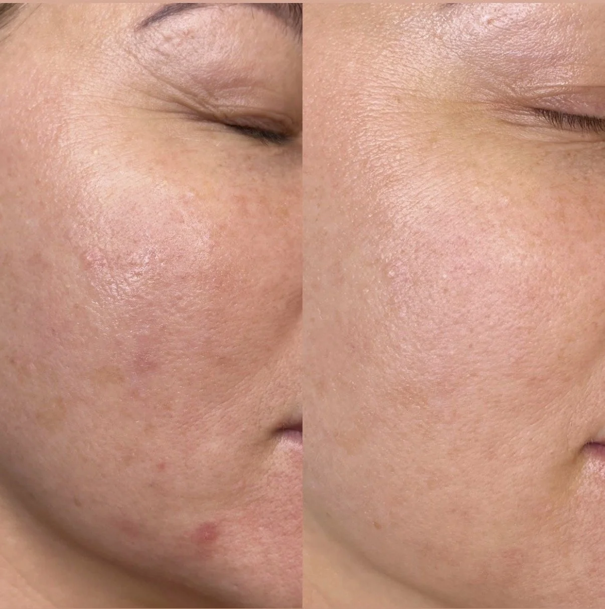 Microneedling vs laser results skin texture improvement