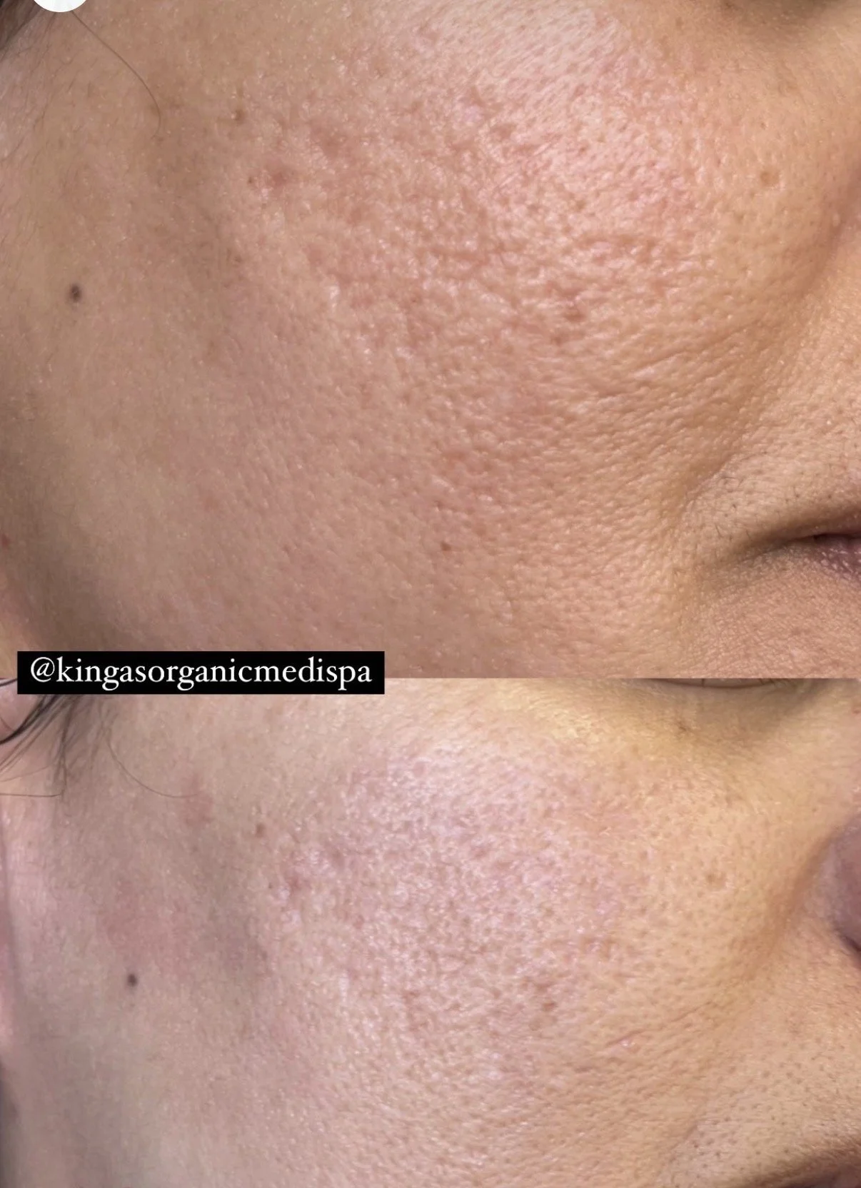 Acne Scarring - Reduction  Before and After – 2 Microneedling Treatments