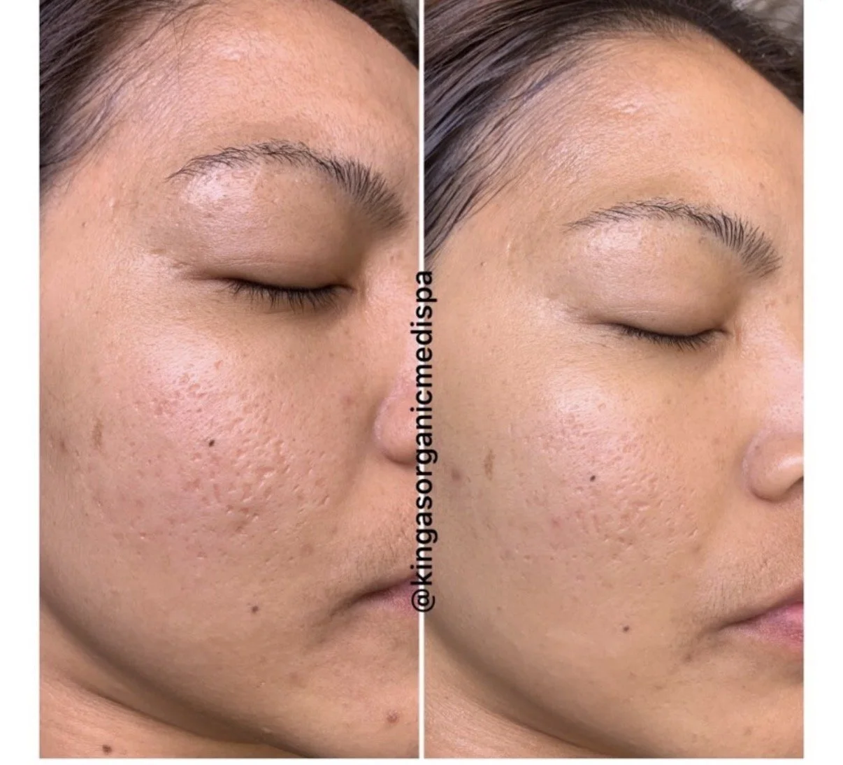 How to Treat Acne Scars in Kitchener Waterloo (What Actually Works)