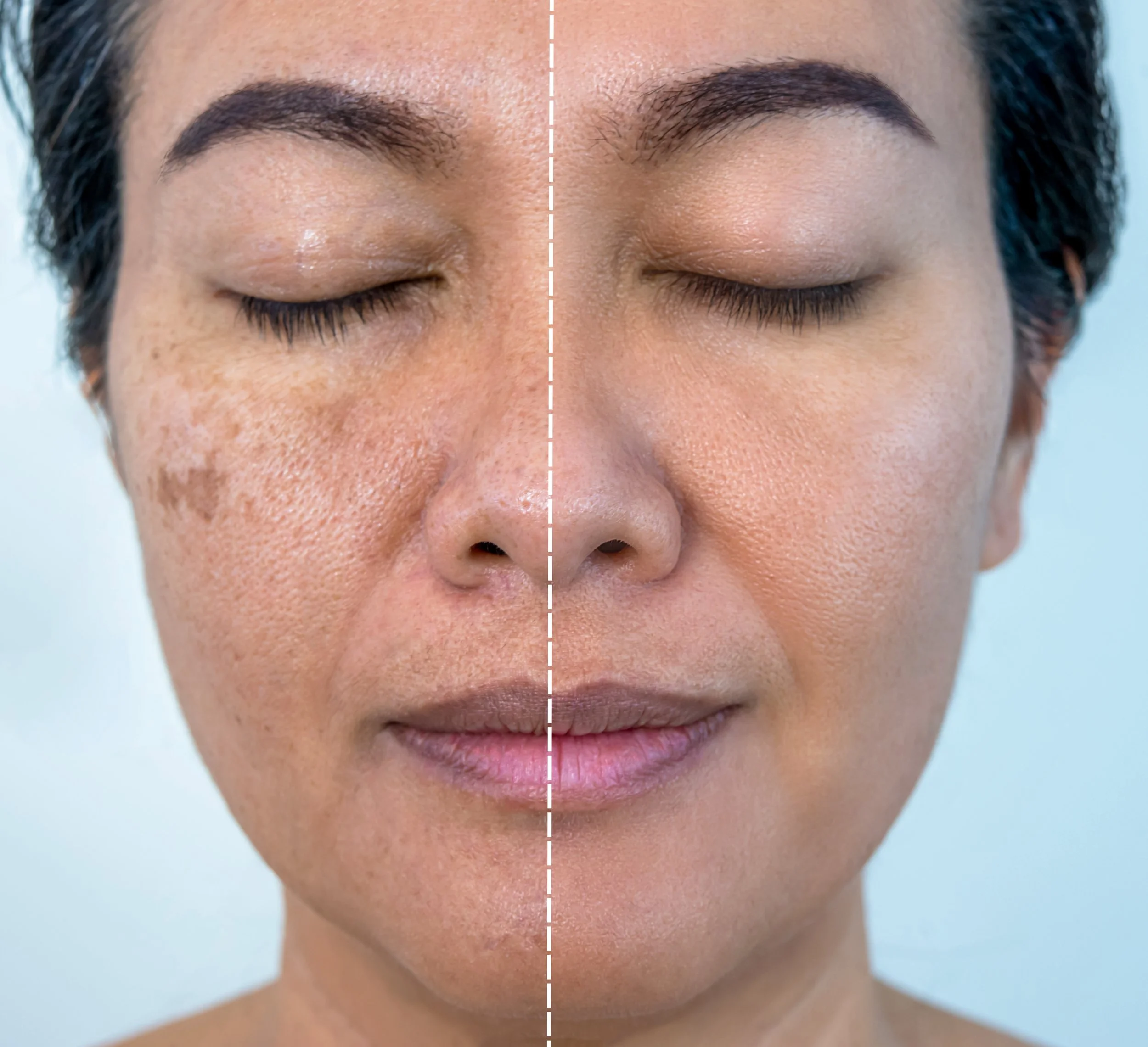 How to Get Rid of Dark Spots on Your Face (Fast &amp; Safely)