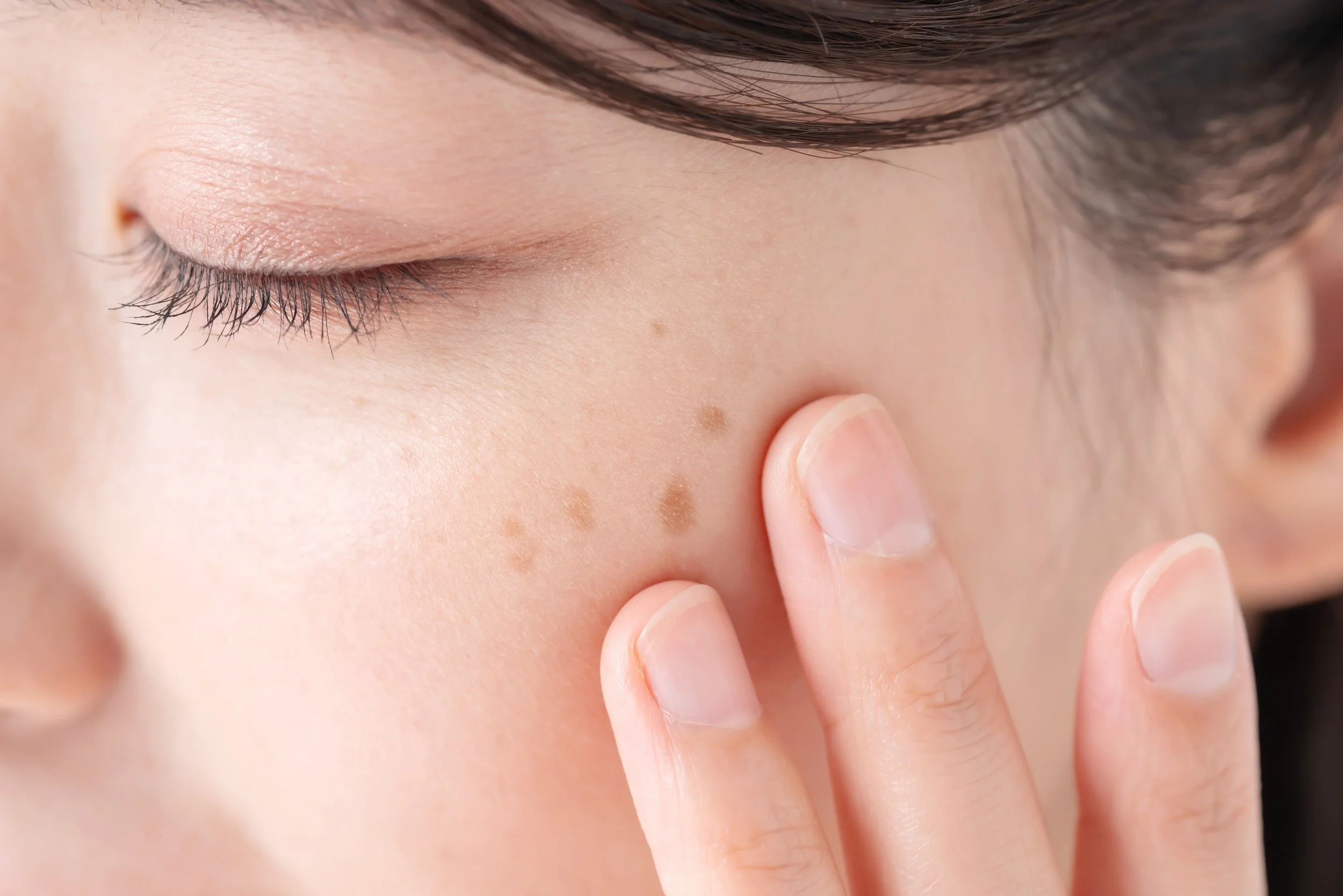 Melasma vs Hyperpigmentation: Understanding the Difference