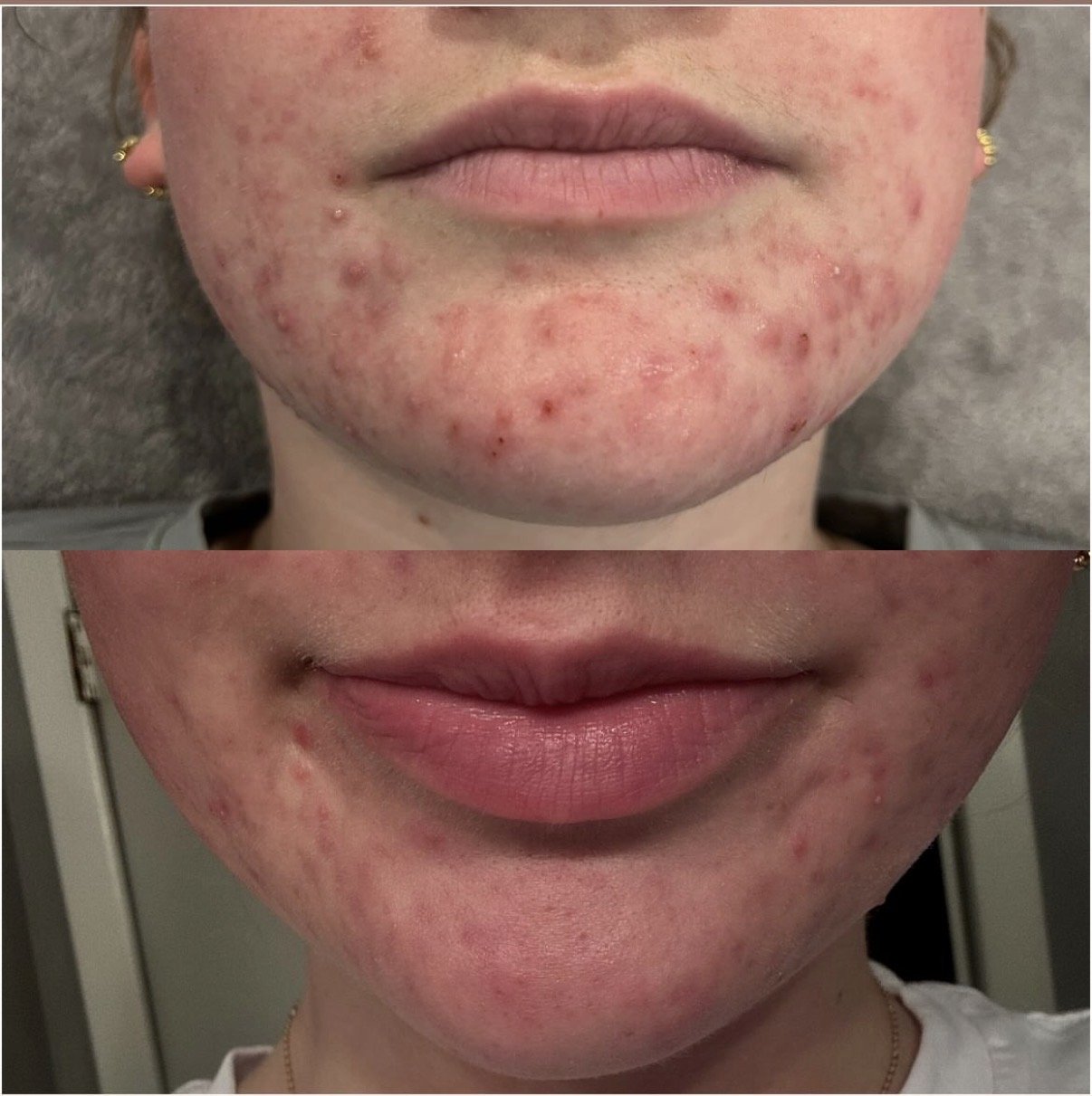 acne laser treatment reduced redness and congestion