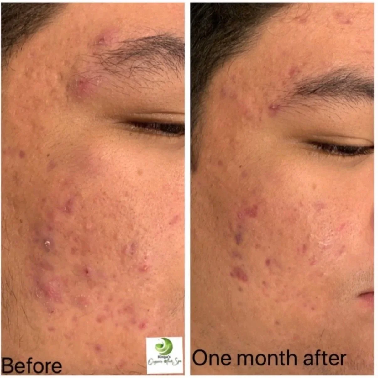 Comparison of a person's facial skin before and after one month of treatment, showing reduction in acne and skin inflammation.