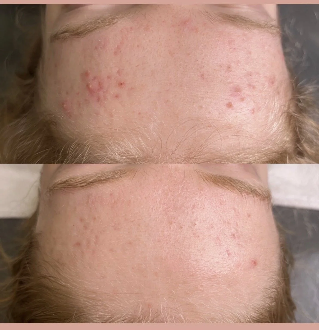 customized acne facial before and after clear skin results