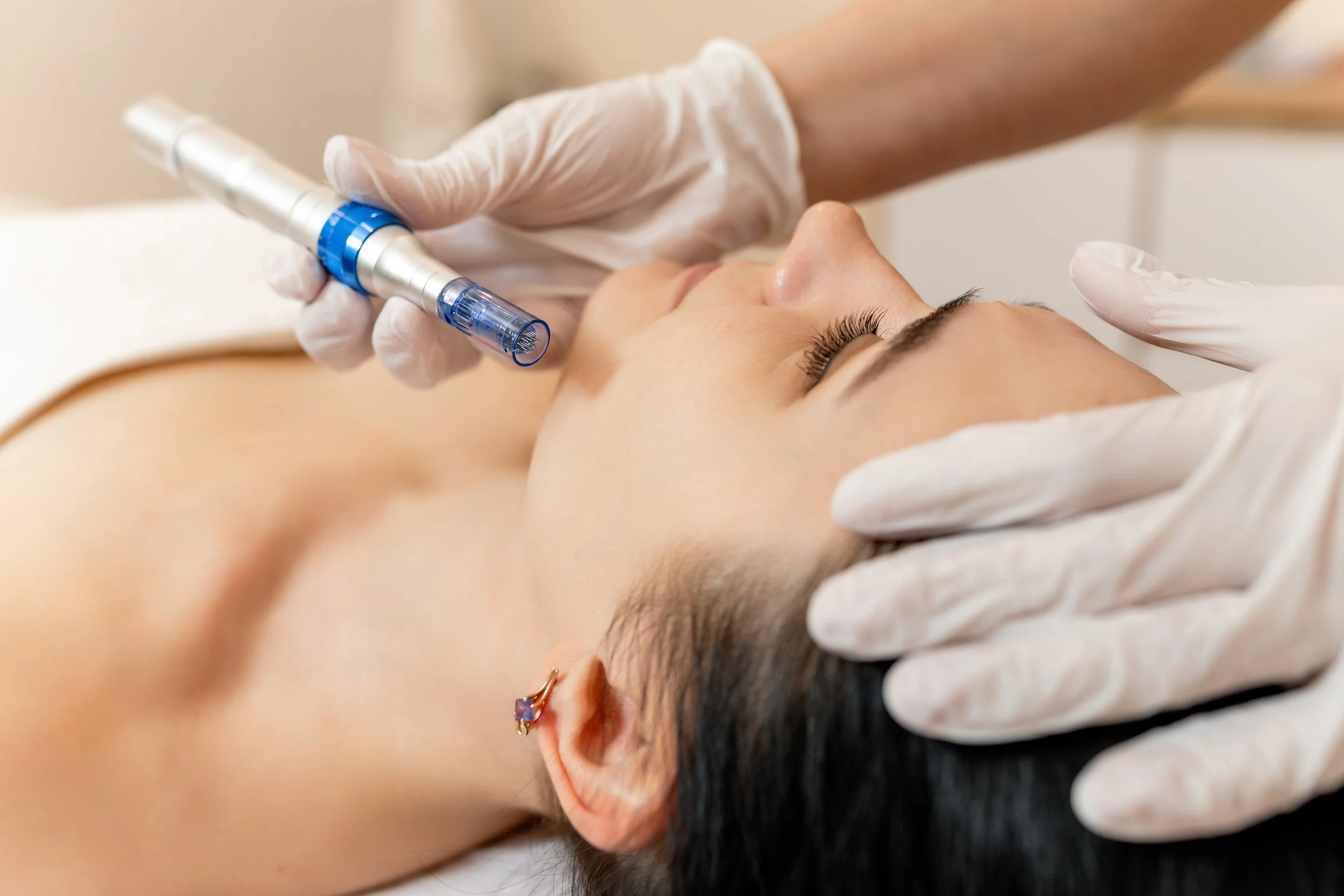 Microneedling Promo