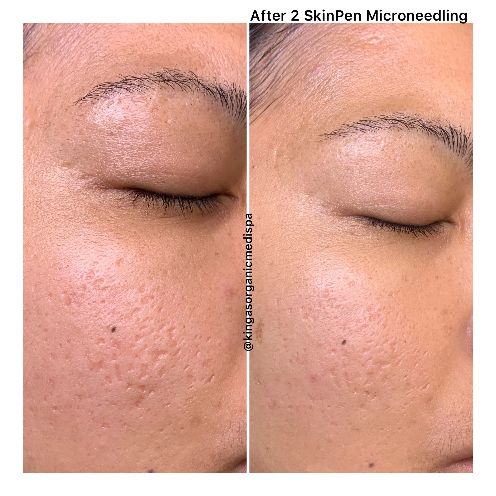 2 Skinpen Microneedling Treatments