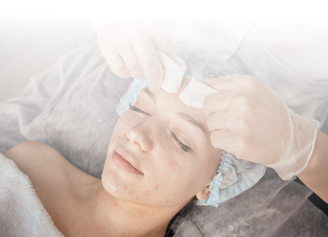 Acne laser treatment