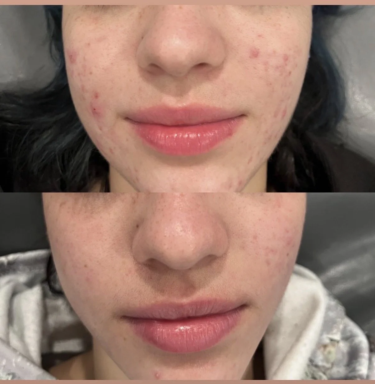 Professional acne facial results Kitchener medi spa