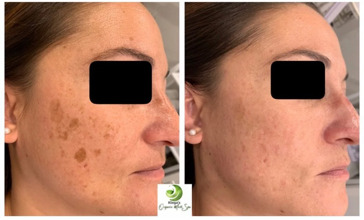 Laser Skin Rejuvenation Treatment