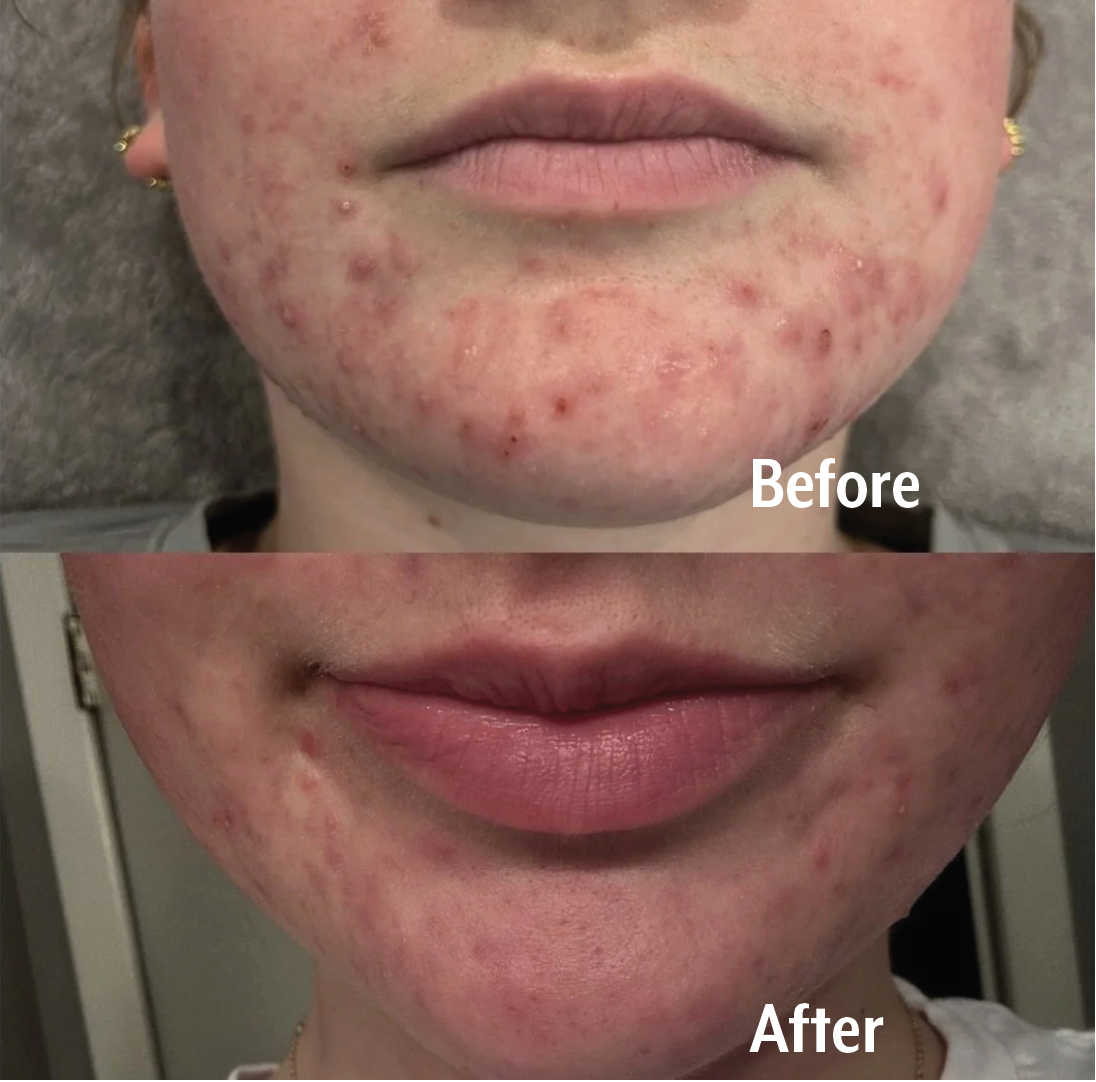 Acne Laser Before & After