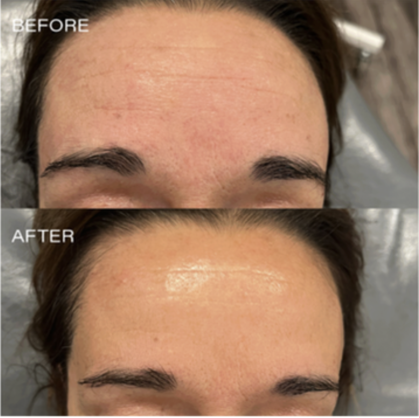 Before and After