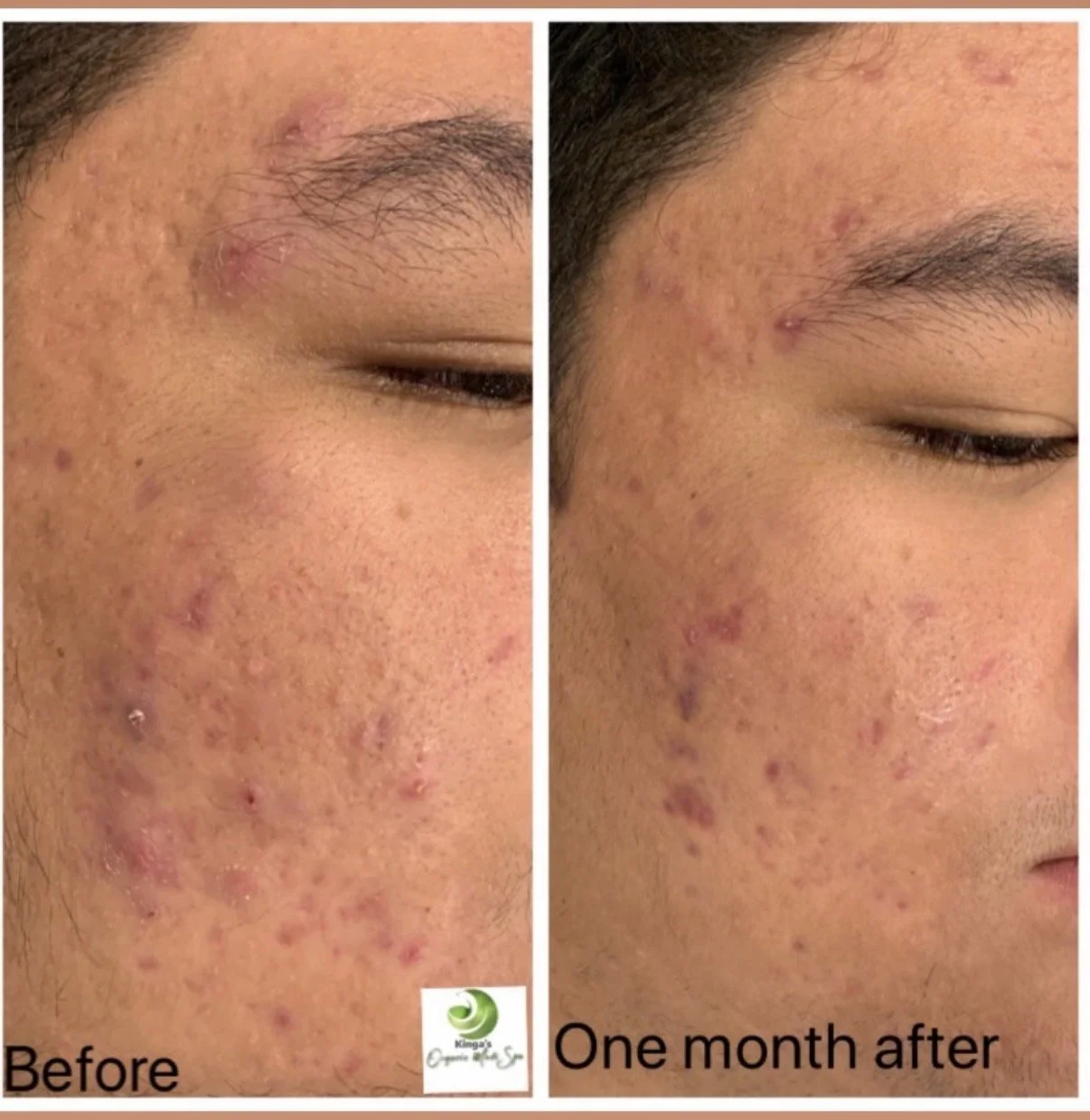 acne treatment results before and after facial Kitchener