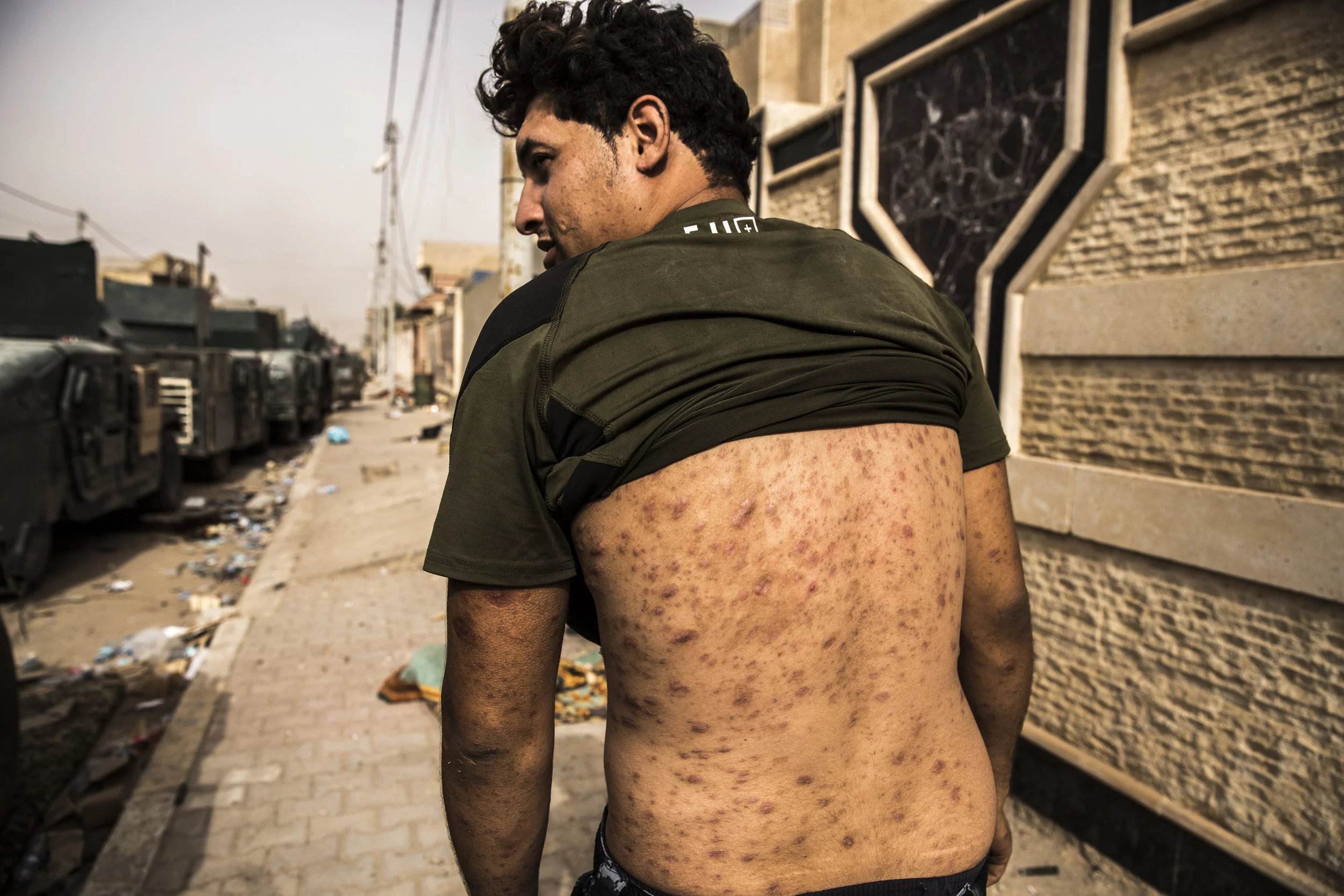  6/19/2016 Fallujah, Iraq  An Iraqi Federal Policeman displayed shrapnel scars on his back from a previous war injury, Sunday, near his units position in the al-Nazal district of Fallujah, near the frontline with ISIS fighters. 