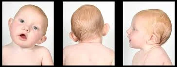 Infant Torticollis