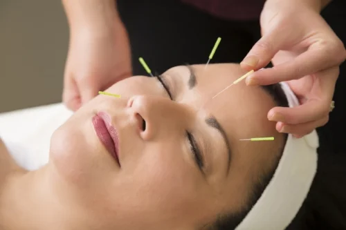 What is Cosmetic Acupuncture?