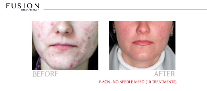 Fusion-BA-F-ACN-NO-NEEDLE-MESO-10-TREATMENTS.jpg